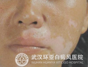 青少年白癜风该怎么护理