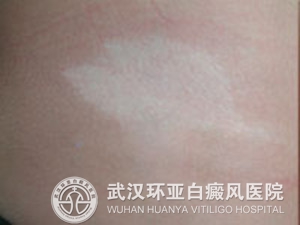 引发白癜风的原因有哪些